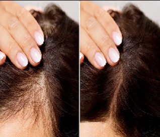 Hair Loss